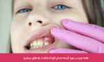 آبسه دندان در کودکان