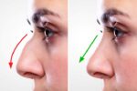 تفاوت‌های بینی گوشتی و استخوانی و نکات کلیدی در انتخاب عمل بینی